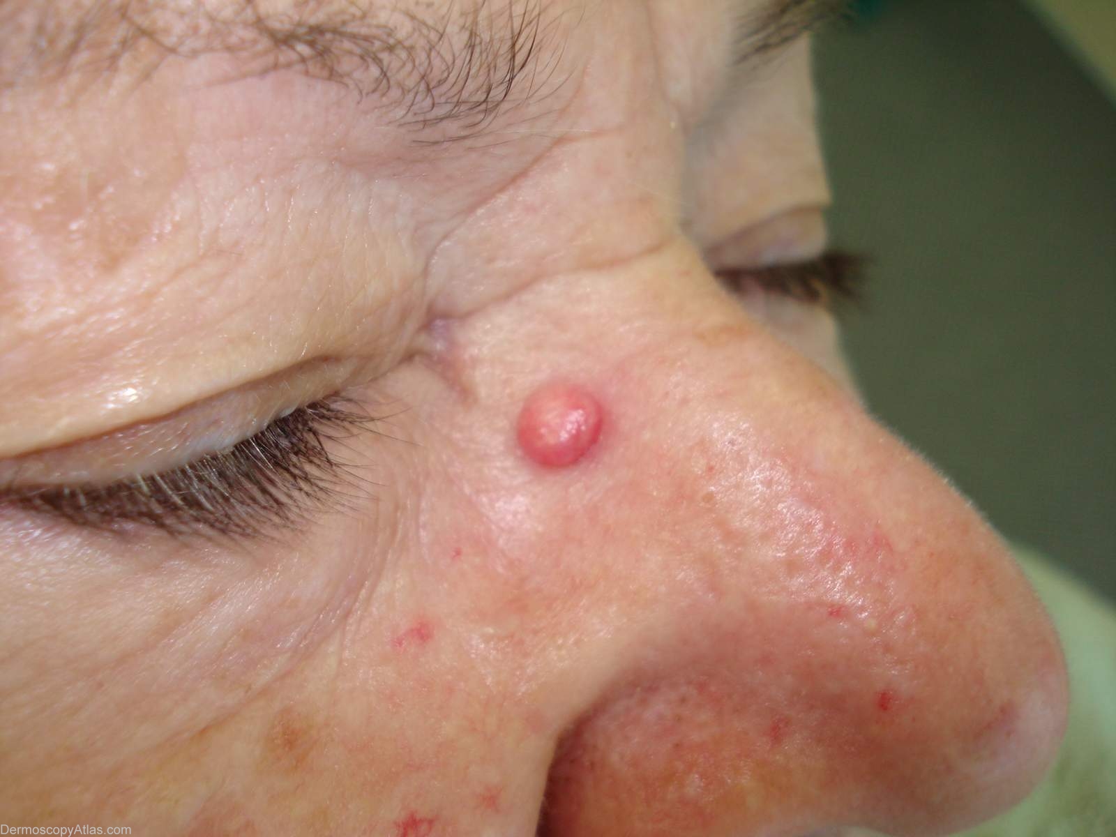 Pyogenic Granuloma Pictures Nose