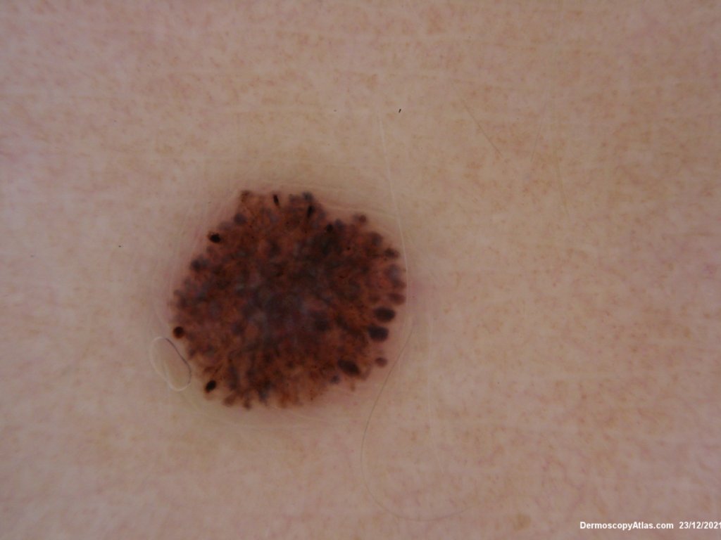 what is spitz melanoma